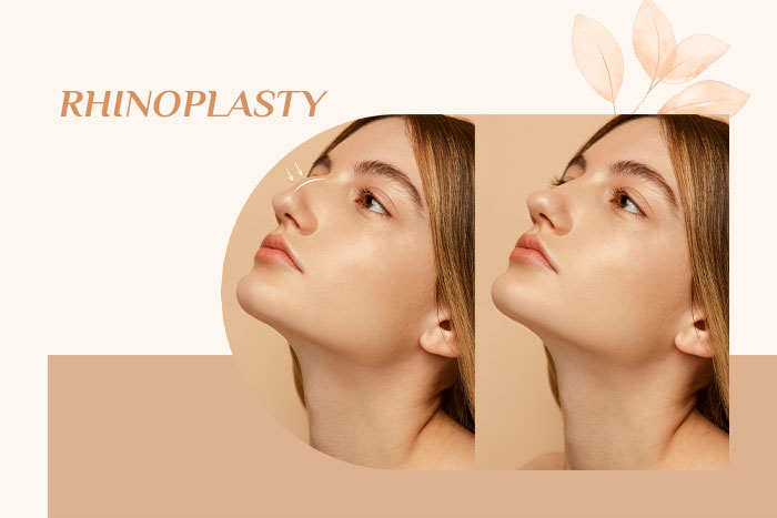 رینوپلاستی بینی